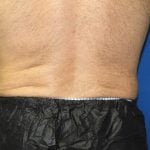 Liposuction Before & After Patient #2741