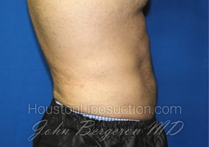 Liposuction Before & After Patient #2741