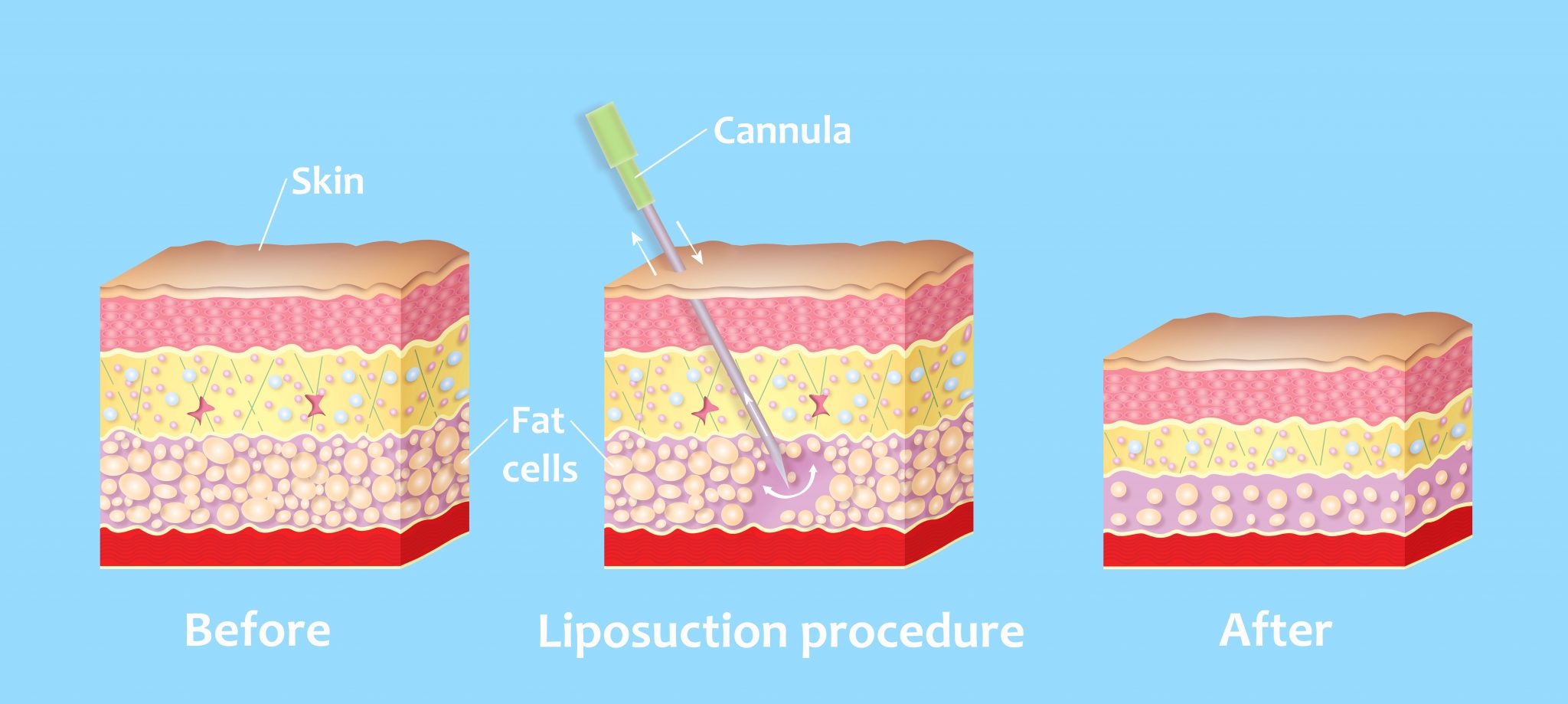 Top 5 Liposuction Myths Houston Lipo Center