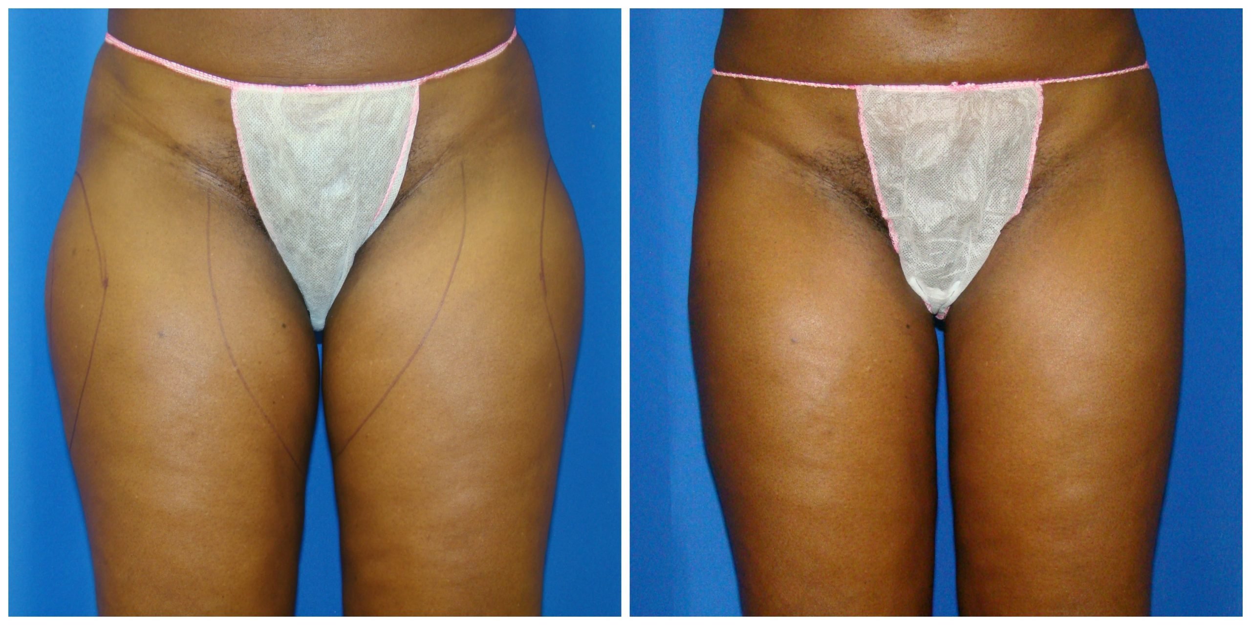 Best Doctor for Thigh Fat Removal - Surgical and Non-Surgical Treatment