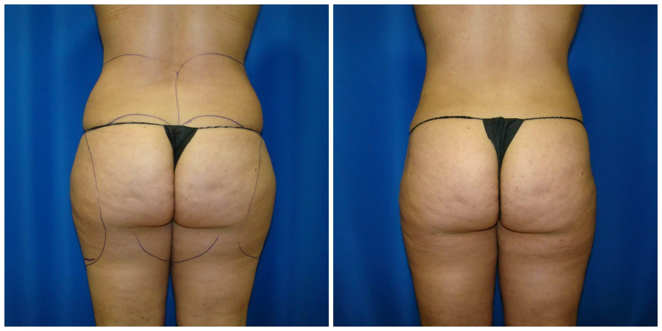 5 Things You Need to Know About Thigh Liposuction - Houston Lipo Center