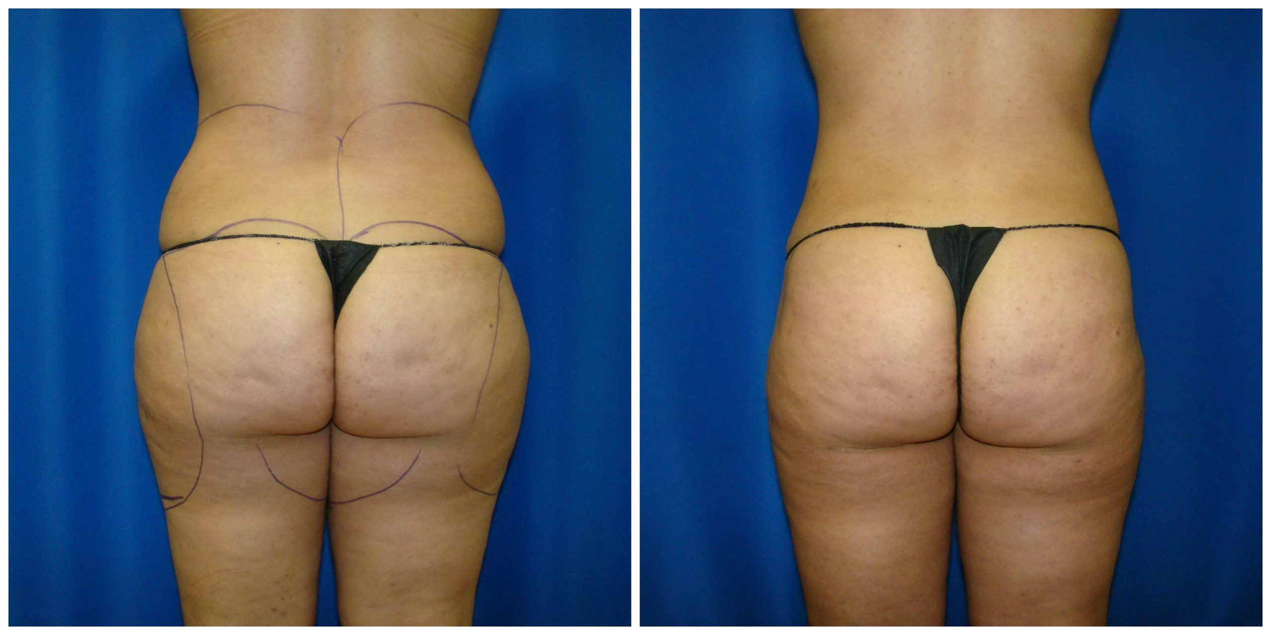 5 Things You Need to Know About Thigh Liposuction - Houston Lipo