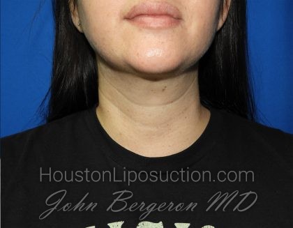 Liposuction Before & After Patient #2799