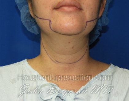 Liposuction Before & After Patient #2799