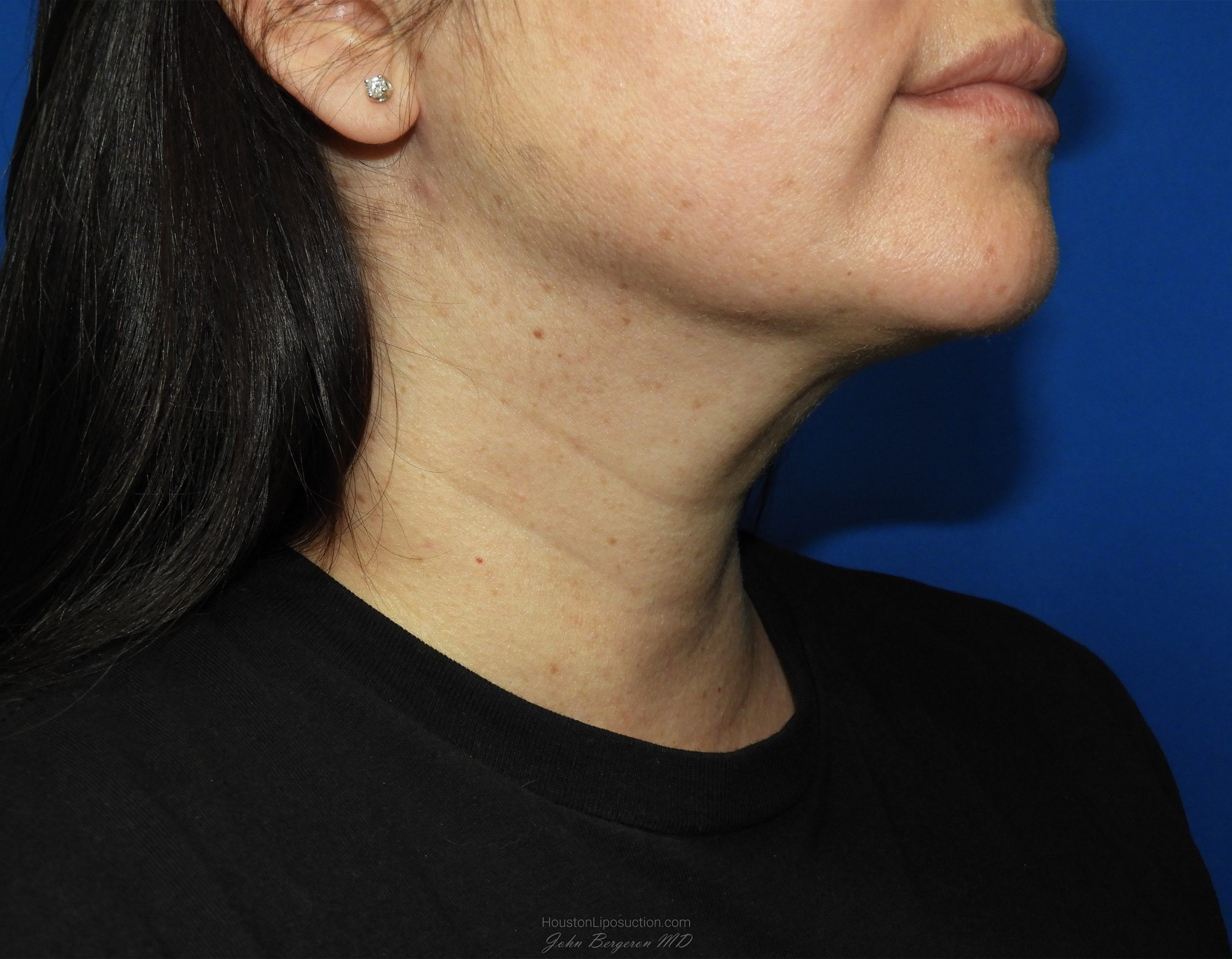 Liposuction Before & After Patient #2799