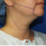 Liposuction Before & After Patient #2799