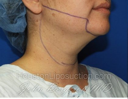 Liposuction Before & After Patient #2799