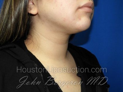 Liposuction Before & After Patient #2850