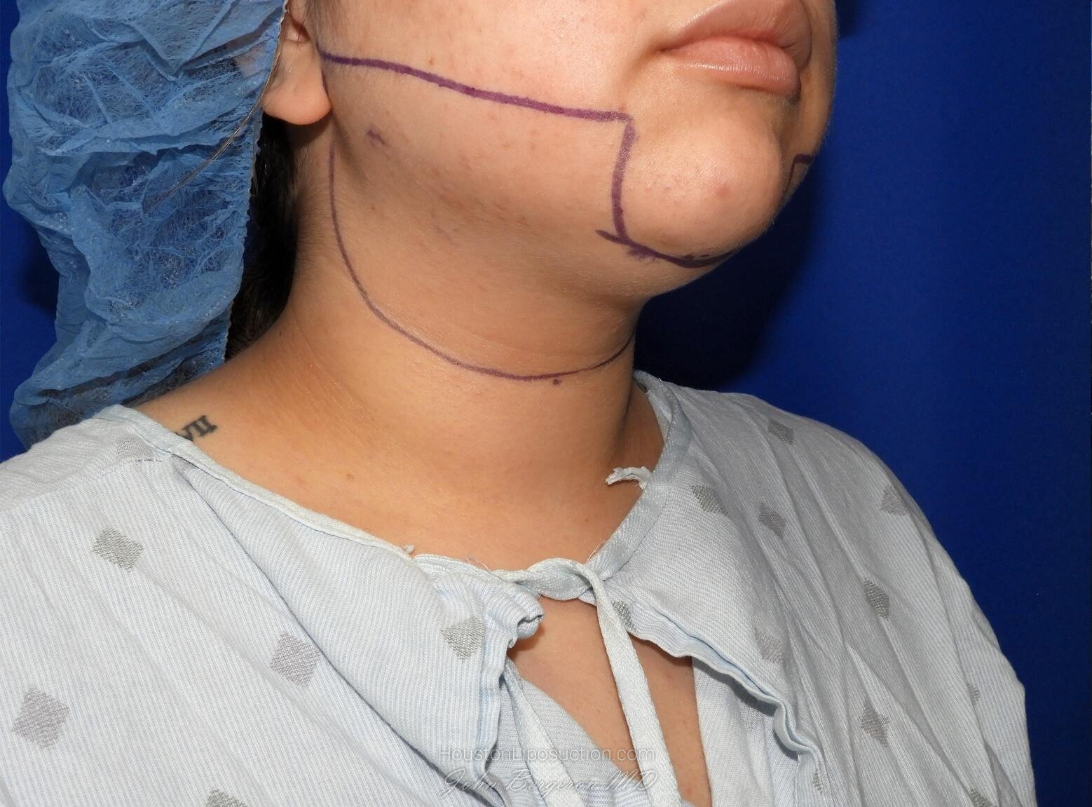 Liposuction Before & After Patient #2850