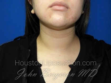 Liposuction Before & After Patient #2850