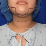 Liposuction Before & After Patient #2850
