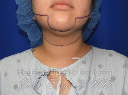 Liposuction Before & After Patient #2850