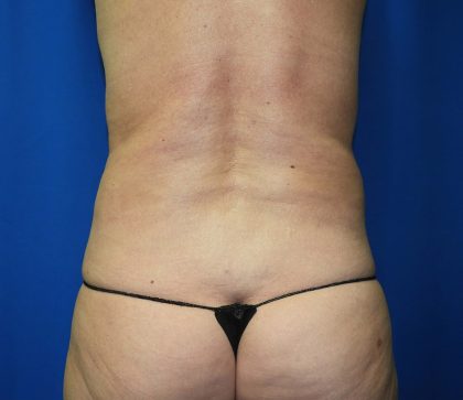 Liposuction Before & After Patient #2873