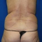 Liposuction Before & After Patient #2873