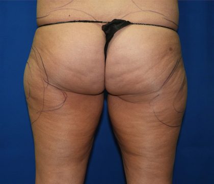 Liposuction Before & After Patient #2873