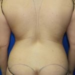 Liposuction Before & After Patient #2890