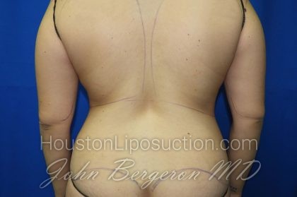 Liposuction Before & After Patient #2890