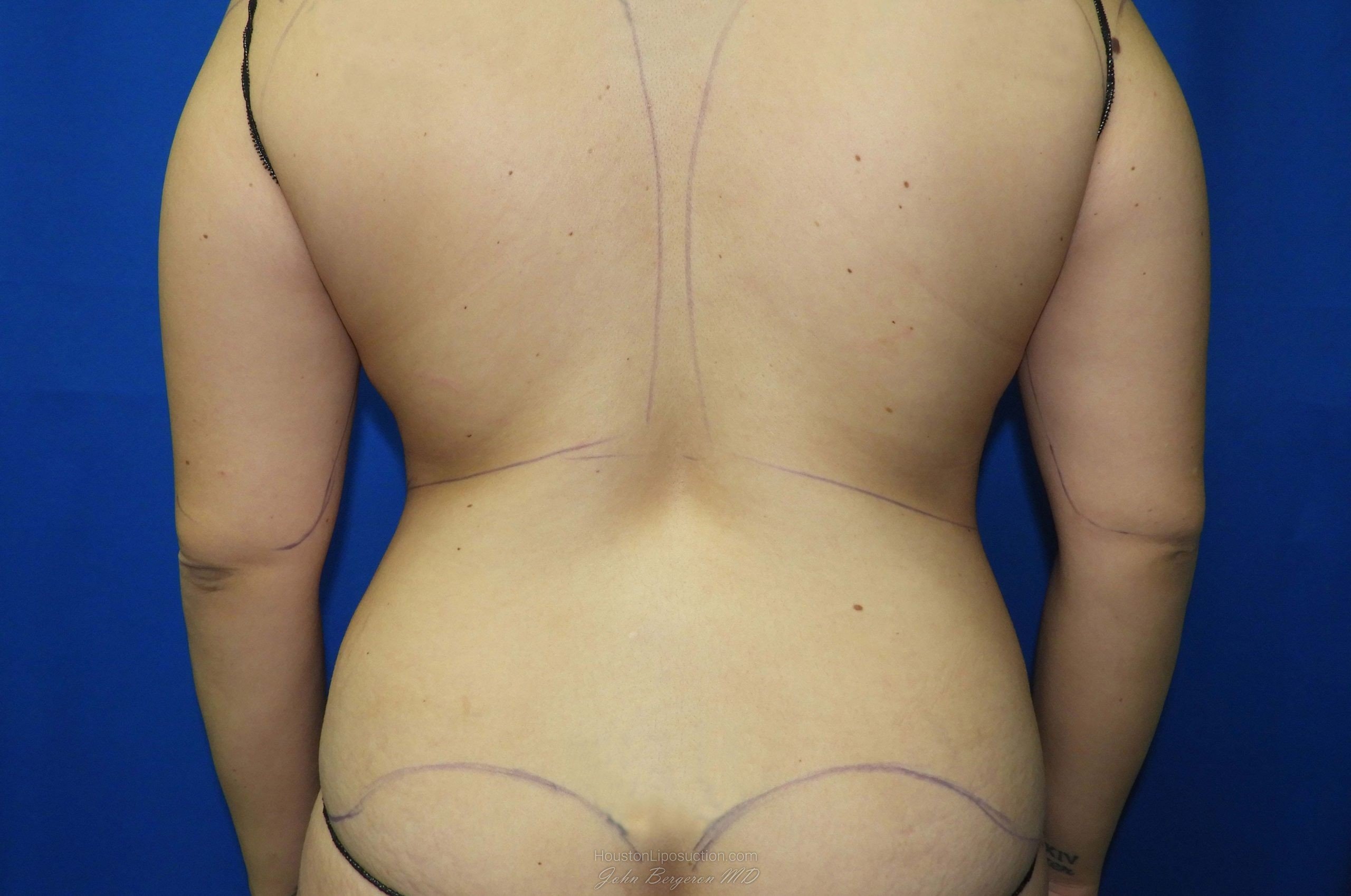 Liposuction Before & After Patient #2890
