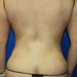 Liposuction Before & After Patient #2890