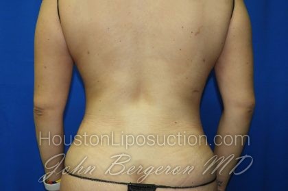 Liposuction Before & After Patient #2890