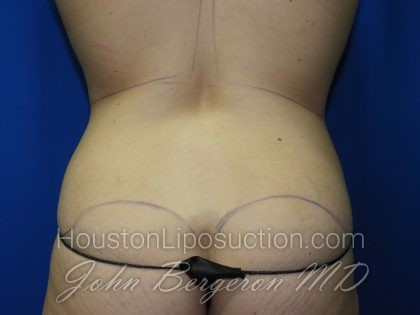 Liposuction Before & After Patient #2890
