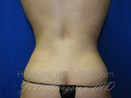 Liposuction Before & After Patient #2890