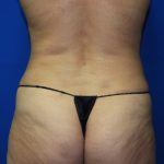 Liposuction Before & After Patient #2889