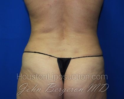 Liposuction Before & After Patient #2889