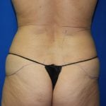 Liposuction Before & After Patient #2889