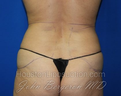 Liposuction Before & After Patient #2889