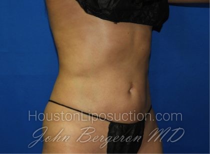Liposuction Before & After Patient #2934