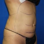 Liposuction Before & After Patient #2934