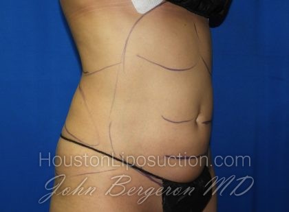 Liposuction Before & After Patient #2934