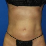 Liposuction Before & After Patient #2934