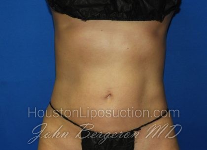 Liposuction Before & After Patient #2934