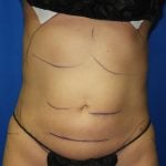 Liposuction Before & After Patient #2934