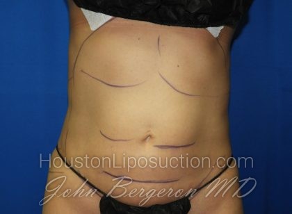 Liposuction Before & After Patient #2934