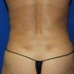 Liposuction Before & After Patient #2934