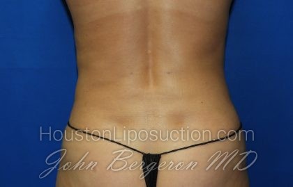 Liposuction Before & After Patient #2934