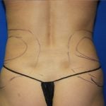 Liposuction Before & After Patient #2934