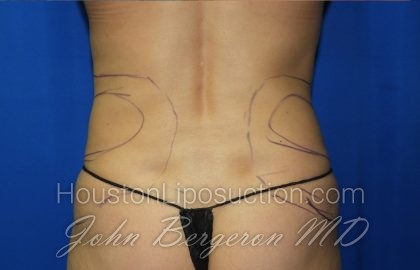 Liposuction Before & After Patient #2934