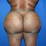 Liposuction Before & After Patient #3002