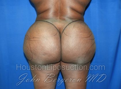 Liposuction Before & After Patient #3002
