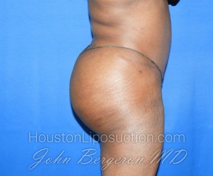 Liposuction Before & After Patient #3002