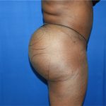 Liposuction Before & After Patient #3002