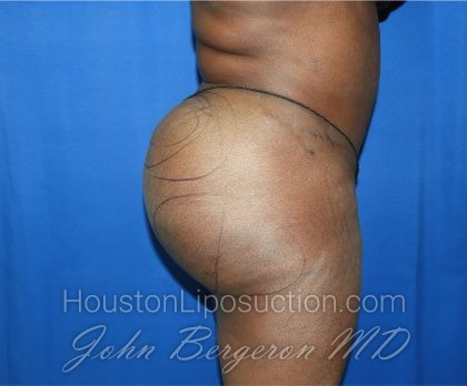 Liposuction Before & After Patient #3002