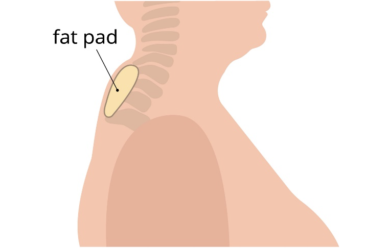 Understanding Dowager's Hump: Causes, Symptoms & Exercises