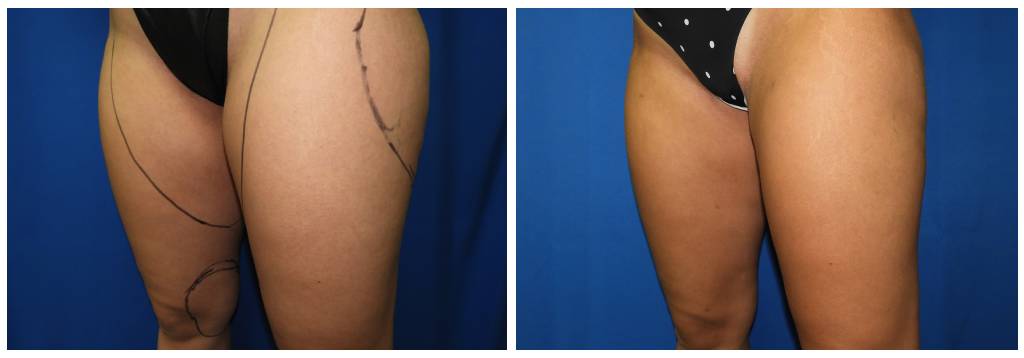 Houston Liposuction BNA Morales 1