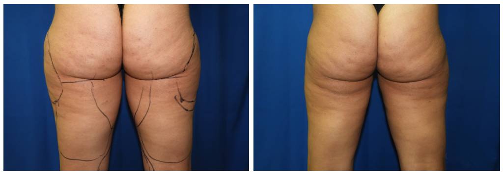 Houston Liposuction BNA Morales 2