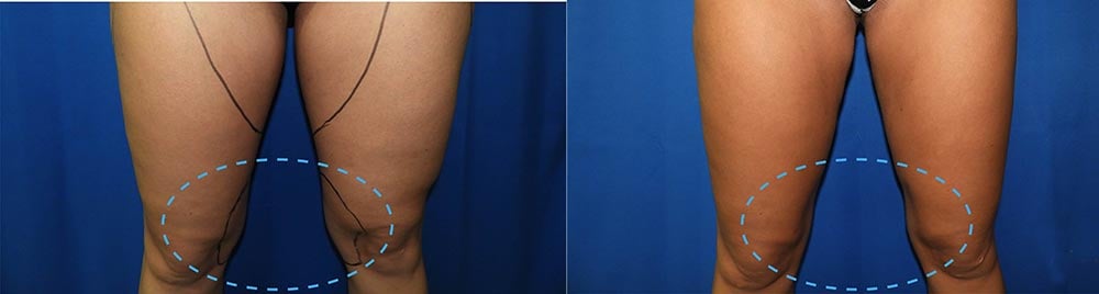 knee Lipo